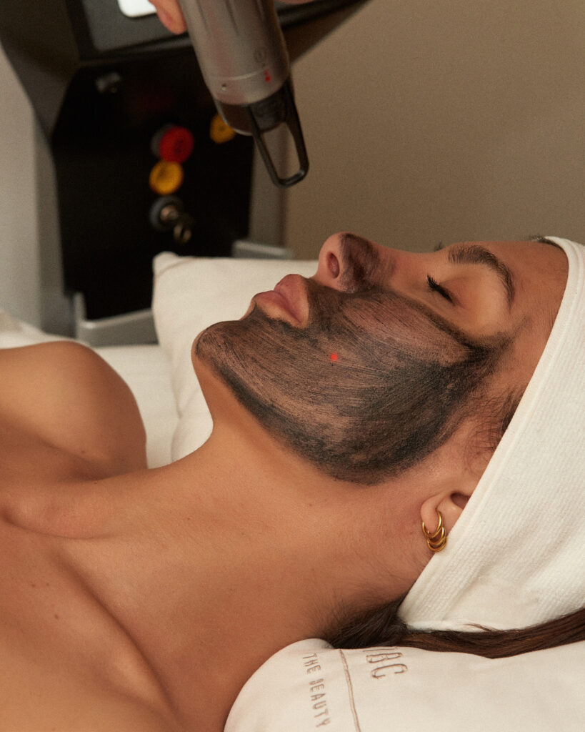 Carbon Peel By Alma Q en The Beauty Concept