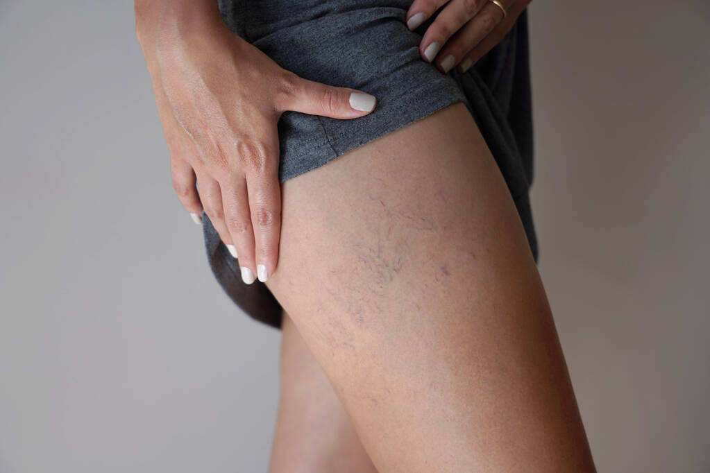 Tratamiento de Varices